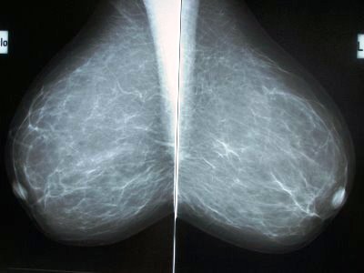 normal mammograms2