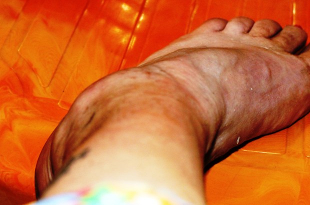 The sprain was a drain 